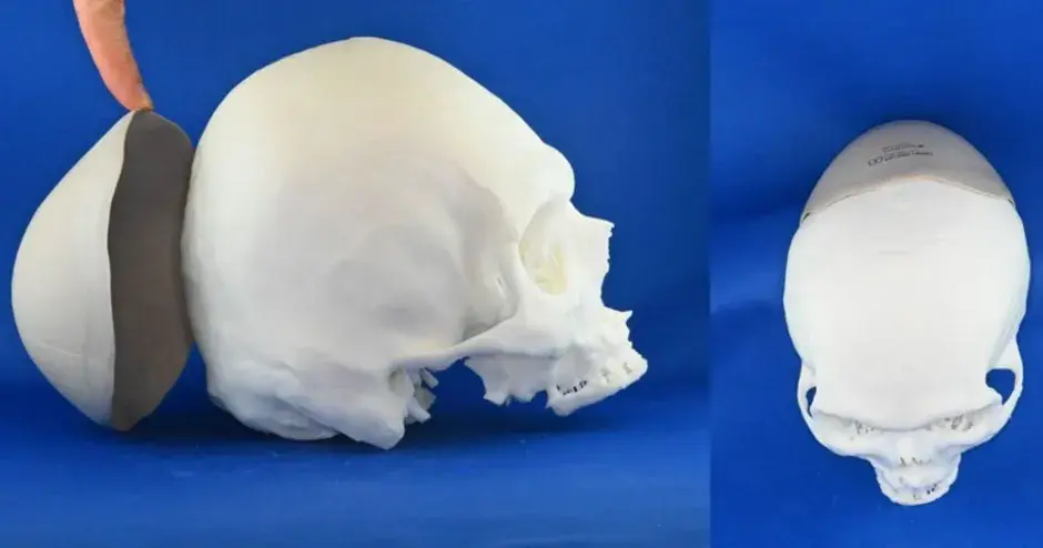 3D printed implants